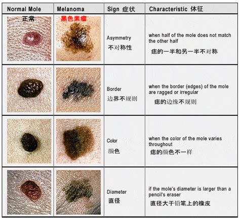 阴部长痣|阴部黏膜有痣怎么办？会癌变吗？